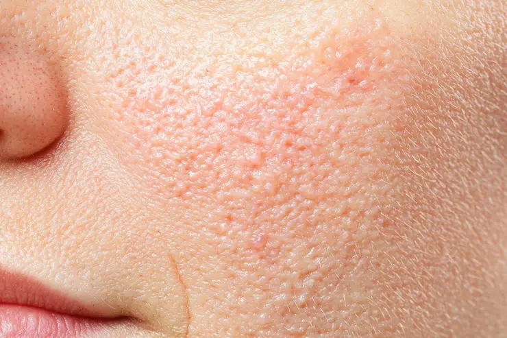 نیاسینامید یا رتینول؛ کدام برای منافذ باز پوست بهتر است؟