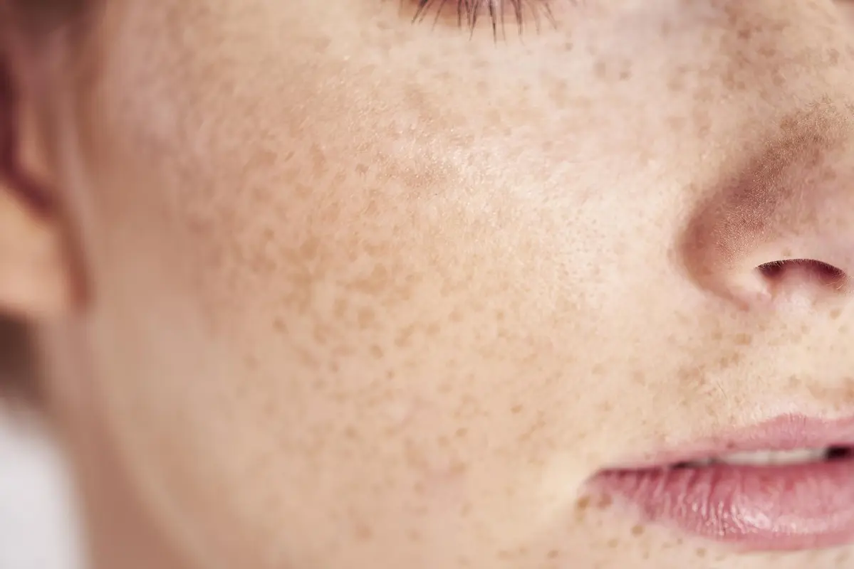 چه ترکیباتی تو تابستون بیشتر باعث لک میشن؟ مراقب این مواد باش!